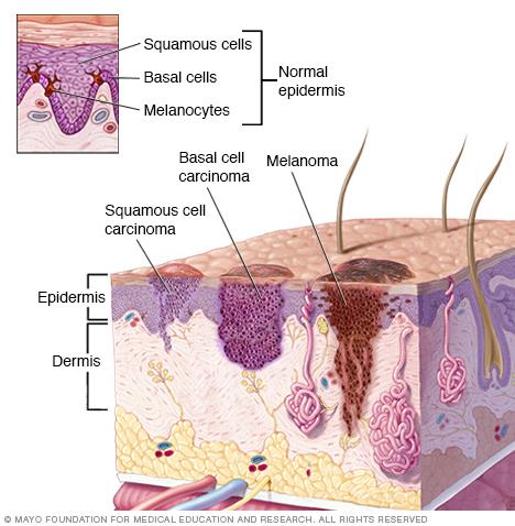 Where skin cancer develops